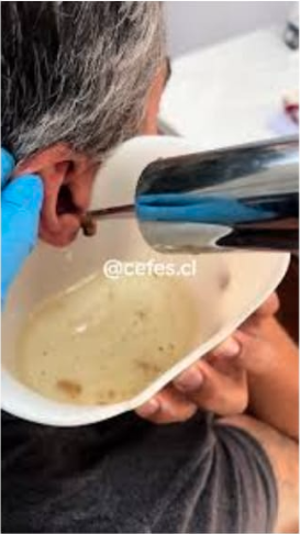 Lavado de Oídos